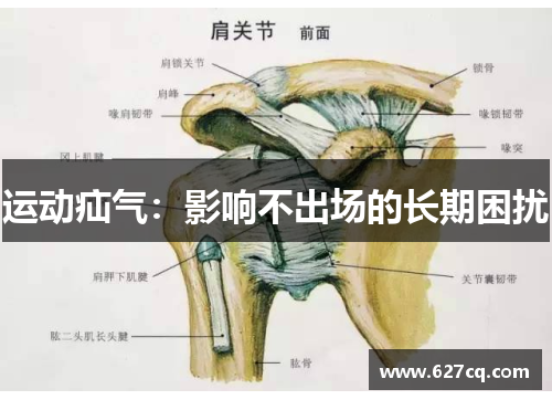 运动疝气：影响不出场的长期困扰